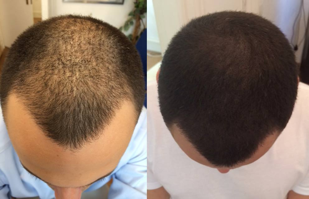 Covering Up Baldness with Micro Scalp Pigmentation
