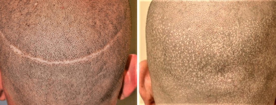 How to Cover Hair Transplant Scars with SMP - Scalp Designs: