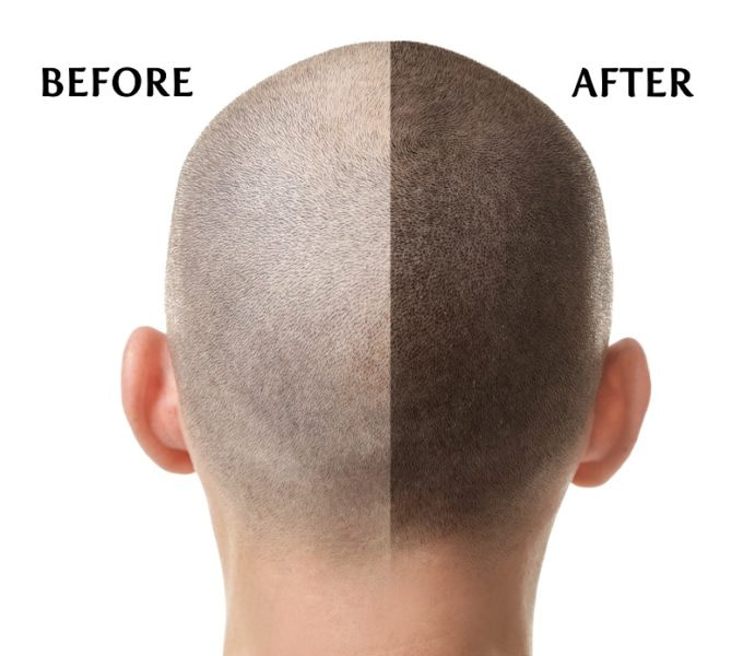 Scalp MicroPigmentation Results – Before And After
