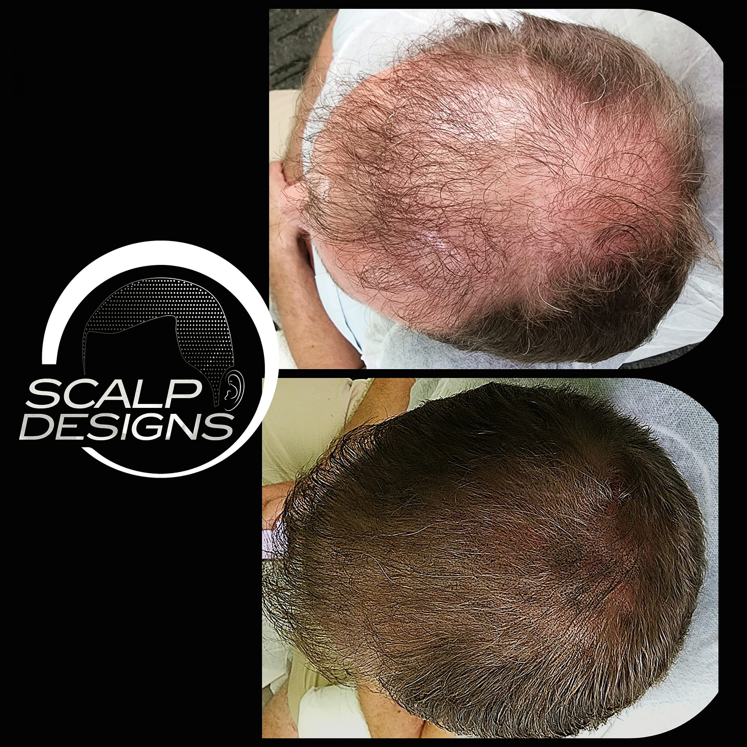 SMP For Long Hair - Scalp Designs: