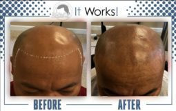 receding hair loss treatment