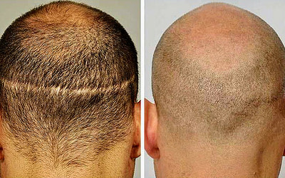 How Scalp Micropigmentation can Cover Scalp Scars