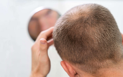 6 Best Hair Loss Treatments for Thinning Hair