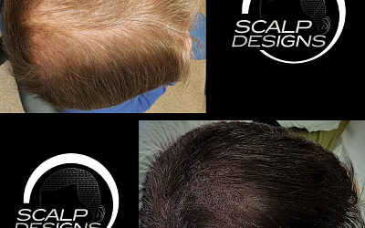 Boston’s Scalp Design: Pioneering the Game in Scalp Micropigmentation