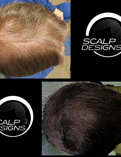 scalp micropigmentation boston