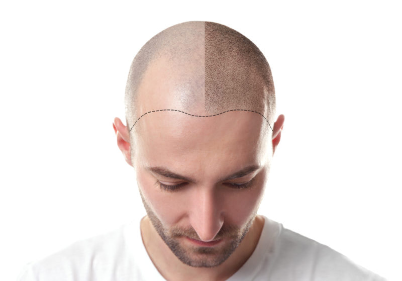 Scalp Micropigmentation Hair Loss Solution